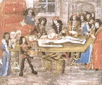 Autopsy in the manuscript of Grande Chirurgie by Gui de Chauliac, Bibliothèque Fac. Méd. Montpellier H 184 f°15v° (second third of the 15th century)